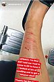 aimee-injury