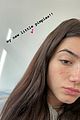 charli-acne