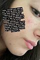 charli-acne
